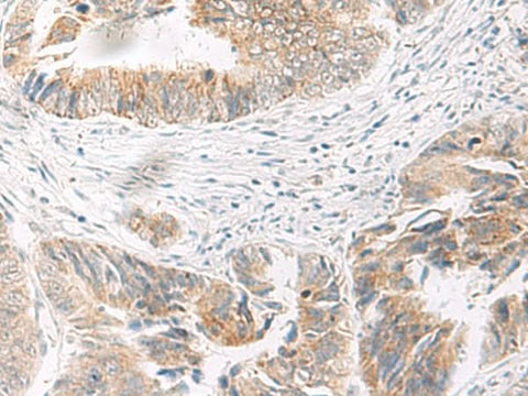 Immunohistochemistry of paraffin-embedded Human colorectal cancer tissue using IDUA Polyclonal Antibody at dilution of 1:35(×200)