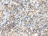 Immunohistochemistry of paraffin-embedded Human lung cancer tissue using NUDT18 Polyclonal Antibody at dilution of 1:40(×200)