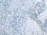 Immunohistochemistry of paraffin-embedded Human liver cancer tissue using GLS Polyclonal Antibody at dilution of 1:60(×200)
