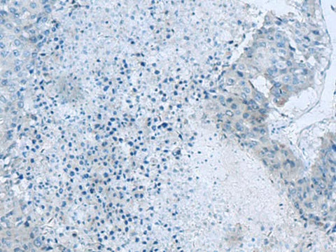 Immunohistochemistry of paraffin-embedded Human liver cancer tissue using GLS Polyclonal Antibody at dilution of 1:60(×200)