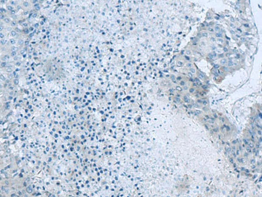 Immunohistochemistry of paraffin-embedded Human liver cancer tissue using GLS Polyclonal Antibody at dilution of 1:60(×200)