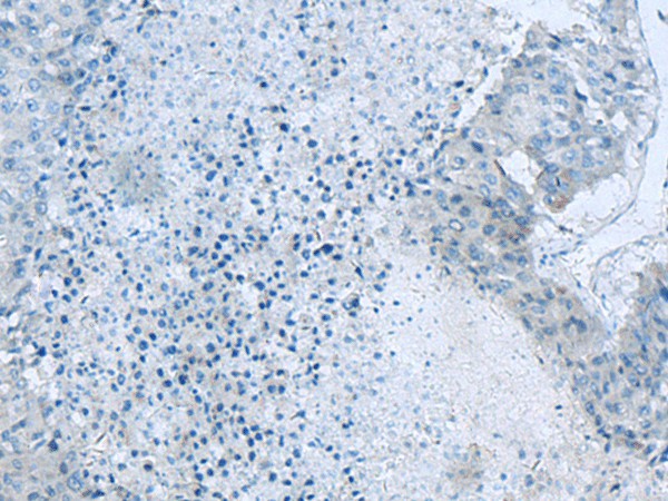 Immunohistochemistry of paraffin-embedded Human liver cancer tissue using GLS Polyclonal Antibody at dilution of 1:60(×200)