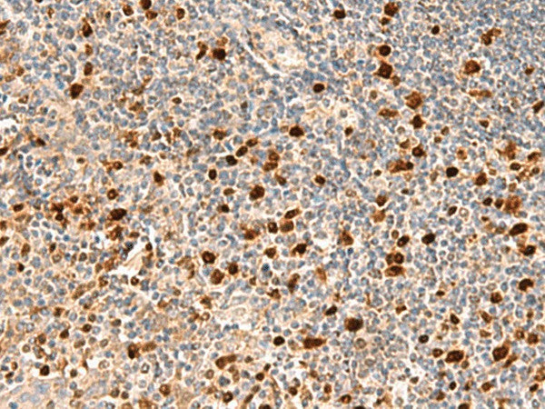 Immunohistochemistry of paraffin-embedded Human tonsil tissue using DUT Polyclonal Antibody at dilution of 1:70(×200)