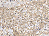 Immunohistochemistry of paraffin-embedded Human esophagus cancer tissue using NEUROG3 Polyclonal Antibody at dilution of 1:55(×200)