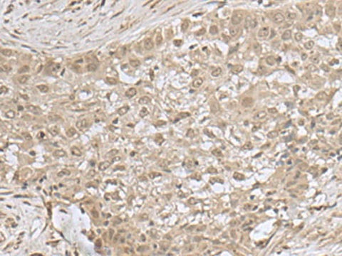 Immunohistochemistry of paraffin-embedded Human esophagus cancer tissue using NEUROG3 Polyclonal Antibody at dilution of 1:55(×200)