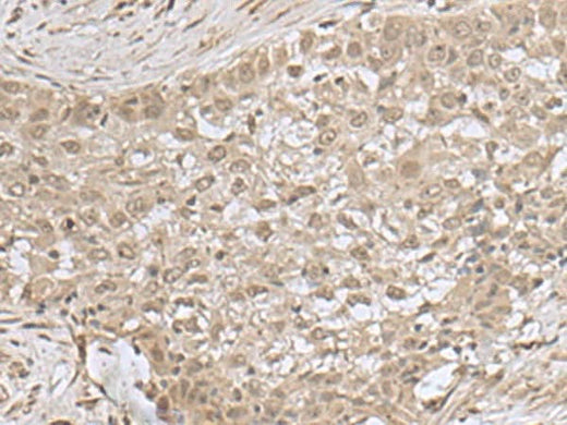 Immunohistochemistry of paraffin-embedded Human esophagus cancer tissue using NEUROG3 Polyclonal Antibody at dilution of 1:55(×200)