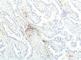 Immunohistochemistry of paraffin-embedded Human lung carcinoma tissue using JAK1 Monoclonal Antibody at dilution of 1:200.