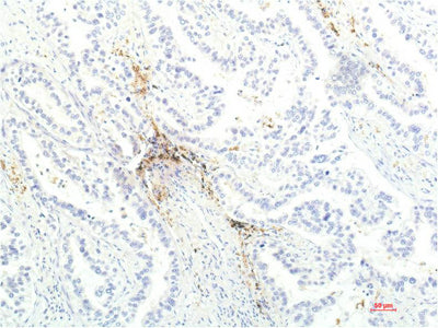 Immunohistochemistry of paraffin-embedded Human lung carcinoma tissue using JAK1 Monoclonal Antibody at dilution of 1:200.