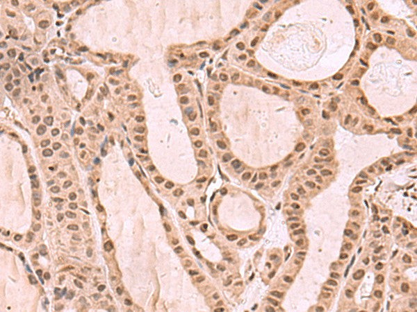 Immunohistochemistry of paraffin-embedded Human thyroid cancer tissue using KDM7A Polyclonal Antibody at dilution of 1:35(×200)