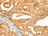 Immunohistochemistry of paraffin-embedded Human thyroid cancer tissue using CEP72 Polyclonal Antibody at dilution of 1:40(×200)