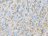 Immunohistochemistry of paraffin-embedded Human liver cancer tissue using PLA2G15 Polyclonal Antibody at dilution of 1:65(×200)