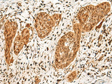 Immunohistochemistry of paraffin-embedded Human esophagus cancer tissue using POLR1E Polyclonal Antibody at dilution of 1:40(×200)