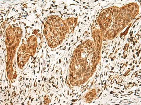 Immunohistochemistry of paraffin-embedded Human esophagus cancer tissue using POLR1E Polyclonal Antibody at dilution of 1:40(×200)