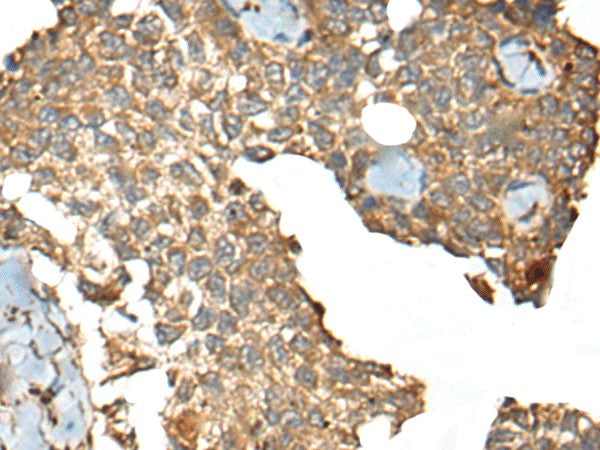 Immunohistochemistry of paraffin-embedded Human ovarian cancer tissue using CCDC113 Polyclonal Antibody at dilution of 1:35(×200)