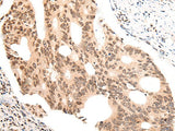 Immunohistochemistry of paraffin-embedded Human colorectal cancer tissue using KNOP1 Polyclonal Antibody at dilution of 1:55(×200)