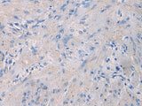 Immunohistochemistry of paraffin-embedded Human gastric cancer tissue using NFKB1 Polyclonal Antibody at dilution of 1:80(×200)