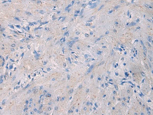 Immunohistochemistry of paraffin-embedded Human gastric cancer tissue using NFKB1 Polyclonal Antibody at dilution of 1:80(×200)
