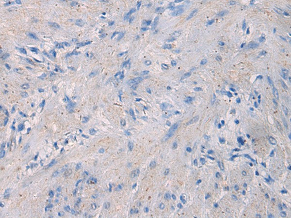 Immunohistochemistry of paraffin-embedded Human gastric cancer tissue using NFKB1 Polyclonal Antibody at dilution of 1:80(×200)