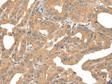 Immunohistochemistry of paraffin-embedded Human thyroid cancer tissue using PPP3R1 Polyclonal Antibody at dilution of 1:55(×200)