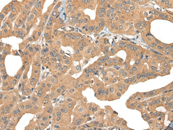 Immunohistochemistry of paraffin-embedded Human thyroid cancer tissue using PPP3R1 Polyclonal Antibody at dilution of 1:55(×200)