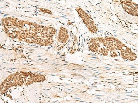 Immunohistochemistry of paraffin-embedded Human esophagus cancer tissue using HUS1 Polyclonal Antibody at dilution of 1:45(×200)