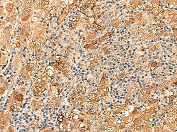 Immunohistochemistry of paraffin-embedded Human liver cancer tissue using KCNE3 Polyclonal Antibody at dilution of 1:60(×200)