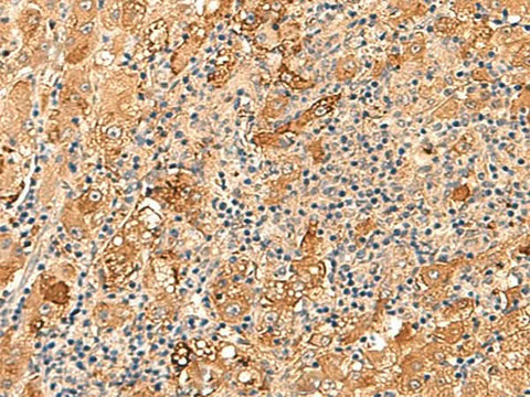 Immunohistochemistry of paraffin-embedded Human liver cancer tissue using KCNE3 Polyclonal Antibody at dilution of 1:60(×200)