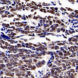 Immunohistochemistry analysis of paraffin-embedded human lung cancer using HDAC1 Polyclonal Antibody at dilution of 1:300.