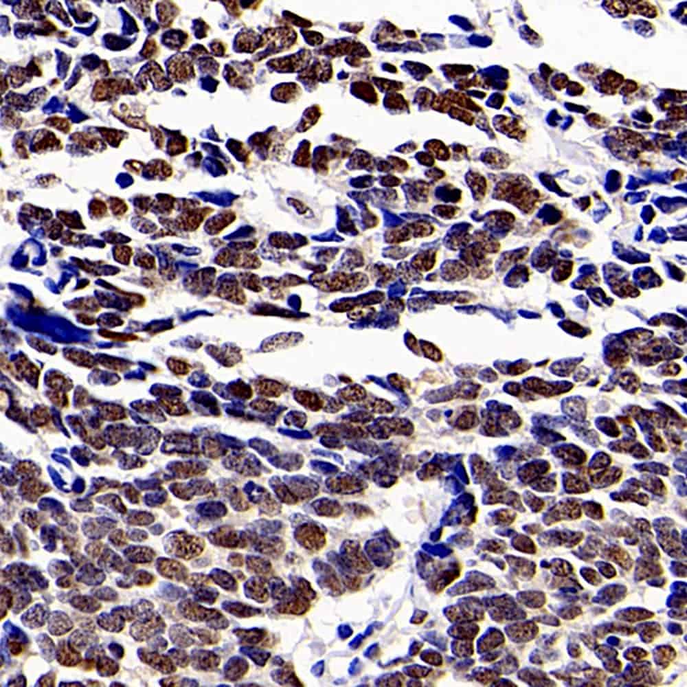 Immunohistochemistry analysis of paraffin-embedded human lung cancer using HDAC1 Polyclonal Antibody at dilution of 1:300.