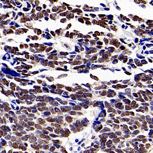 Immunohistochemistry analysis of paraffin-embedded human lung cancer using HDAC1 Polyclonal Antibody at dilution of 1:300.