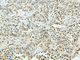 Immunohistochemistry of paraffin-embedded Human ovarian cancer tissue using THTPA Polyclonal Antibody at dilution of 1:90(×200)