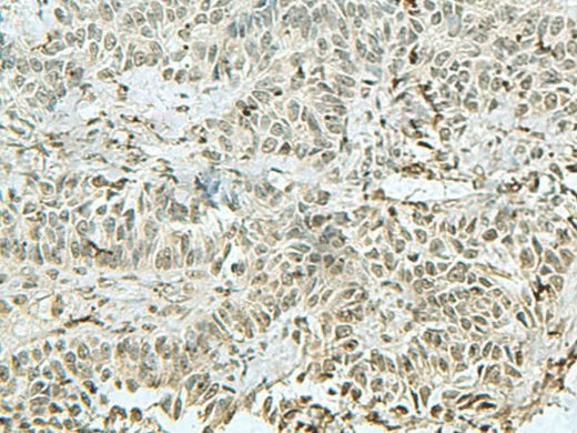 Immunohistochemistry of paraffin-embedded Human ovarian cancer tissue using THTPA Polyclonal Antibody at dilution of 1:90(×200)