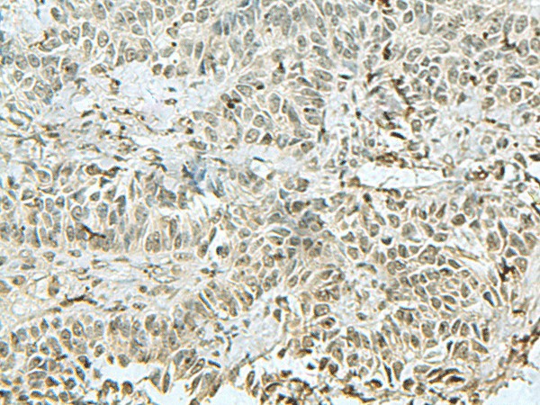 Immunohistochemistry of paraffin-embedded Human ovarian cancer tissue using THTPA Polyclonal Antibody at dilution of 1:90(×200)