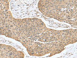 Immunohistochemistry of paraffin-embedded Human esophagus cancer tissue using CSRP2 Polyclonal Antibody at dilution of 1:70(×200)
