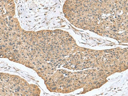 Immunohistochemistry of paraffin-embedded Human esophagus cancer tissue using CSRP2 Polyclonal Antibody at dilution of 1:70(×200)