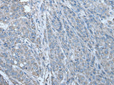 Immunohistochemistry of paraffin-embedded Human liver cancer tissue using ZC3HAV1 Polyclonal Antibody at dilution of 1:70(×200)