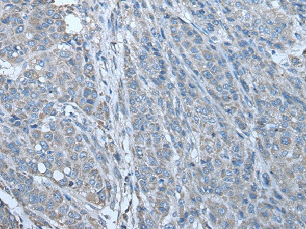 Immunohistochemistry of paraffin-embedded Human liver cancer tissue using ZC3HAV1 Polyclonal Antibody at dilution of 1:70(×200)