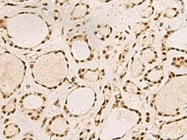 Immunohistochemistry of paraffin-embedded Human thyroid cancer tissue using SAP30BP Polyclonal Antibody at dilution of 1:45(×200)