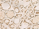 Immunohistochemistry of paraffin-embedded Human thyroid cancer tissue using SAP30BP Polyclonal Antibody at dilution of 1:45(×200)