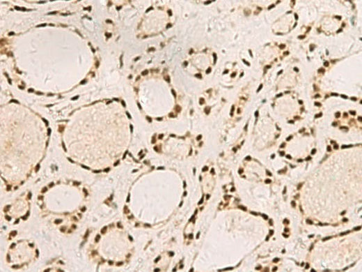 Immunohistochemistry of paraffin-embedded Human thyroid cancer tissue using SAP30BP Polyclonal Antibody at dilution of 1:45(×200)