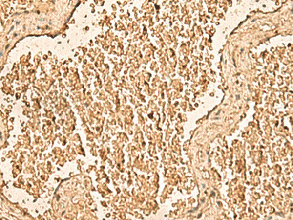 Immunohistochemistry of paraffin-embedded Human gastric cancer tissue using WDR33 Polyclonal Antibody at dilution of 1:50(×200)