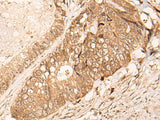 Immunohistochemistry of paraffin-embedded Human colorectal cancer tissue using HIPK3 Polyclonal Antibody at dilution of 1:60(×200)