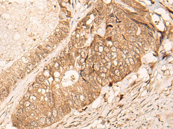 Immunohistochemistry of paraffin-embedded Human colorectal cancer tissue using HIPK3 Polyclonal Antibody at dilution of 1:60(×200)