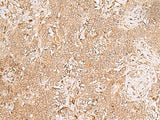 Immunohistochemistry of paraffin-embedded Human ovarian cancer tissue using GMPPB Polyclonal Antibody at dilution of 1:50(×200)