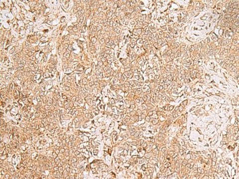 Immunohistochemistry of paraffin-embedded Human ovarian cancer tissue using GMPPB Polyclonal Antibody at dilution of 1:50(×200)