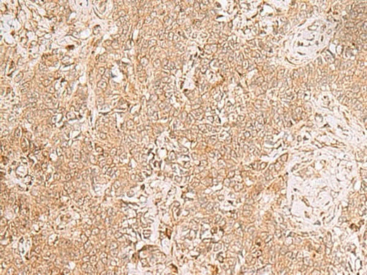 Immunohistochemistry of paraffin-embedded Human ovarian cancer tissue using GMPPB Polyclonal Antibody at dilution of 1:50(×200)