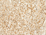 Immunohistochemistry of paraffin-embedded Human gastric cancer tissue using SMUG1 Polyclonal Antibody at dilution of 1:50(×200)