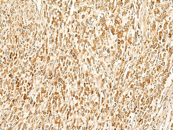 Immunohistochemistry of paraffin-embedded Human gastric cancer tissue using SMUG1 Polyclonal Antibody at dilution of 1:50(×200)