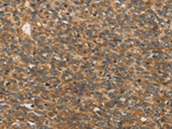 Immunohistochemistry of paraffin-embedded Human ovarian cancer tissue using XPR1 Polyclonal Antibody at dilution of 1:45(×200)