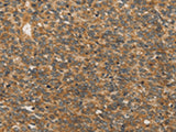 Immunohistochemistry of paraffin-embedded Human ovarian cancer tissue using XPR1 Polyclonal Antibody at dilution of 1:45(×200)